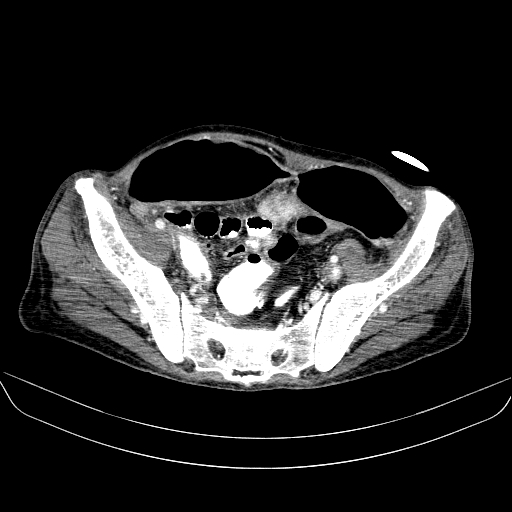 File:Abdominal collection due to previous cecal perforation (Radiopaedia 80831-94320 Axial C+ portal venous phase 165).jpg