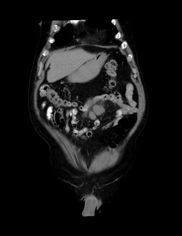 Abdominal lymphoma - with sandwich sign (Radiopaedia 53486-59492 C+ portal venous phase 48).jpg