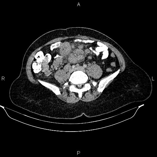 Abdominal lymphoma with sandwich sign (Radiopaedia 84378-99704 Axial C+ portal venous phase 39).jpg