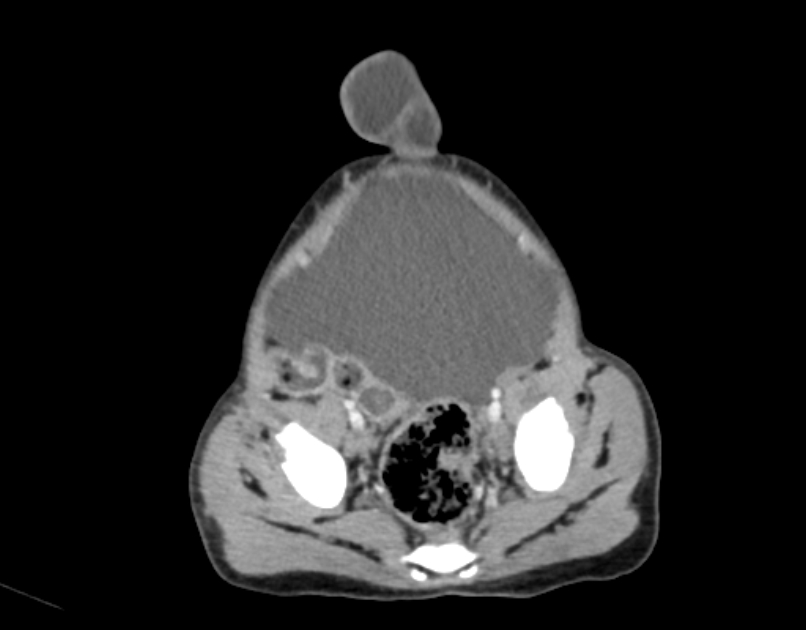 Abdominal premesenteric cystic lymphangioma (Radiopaedia 82995-97350 Axial C+ portal venous phase 57).jpg