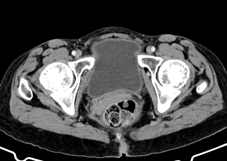 Abdominal wall and retroperitoneal tuberculosis (Radiopaedia 88137-104729 Axial C+ portal venous phase 184).jpg
