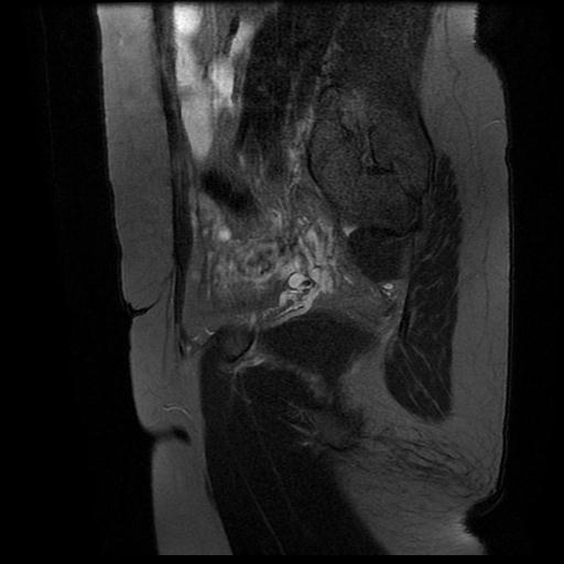 File:Abdominal wall endometriosis (Radiopaedia 83702-98847 Sagittal T2 fat sat 14).jpg