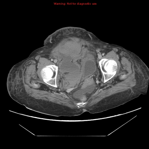 File:Abdominal wall hematoma (Radiopaedia 9427-10112 Axial C+ portal venous phase 99).jpg
