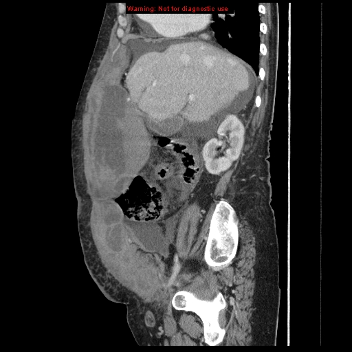 Abdominal wall hematoma (Radiopaedia 9427-10112 Sagittal C+ portal venous phase 72).jpg
