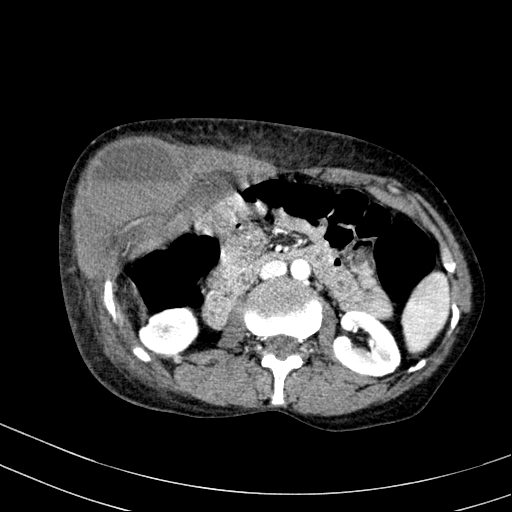 Abdominal wall hematoma with active bleeding (Radiopaedia 83915-99117 Axial renal cortical phase 32).jpg
