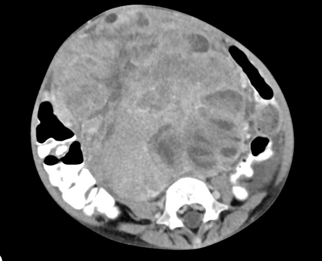 Abdominopelvic rhabdomyosarcoma (Radiopaedia 78356-90984 Axial C+ portal venous phase 109).jpg