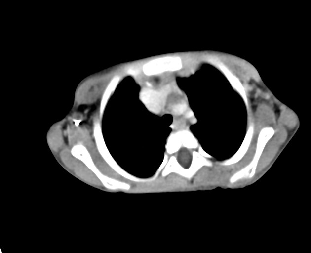 Abdominopelvic rhabdomyosarcoma (Radiopaedia 78356-90984 Axial C+ portal venous phase 8).jpg