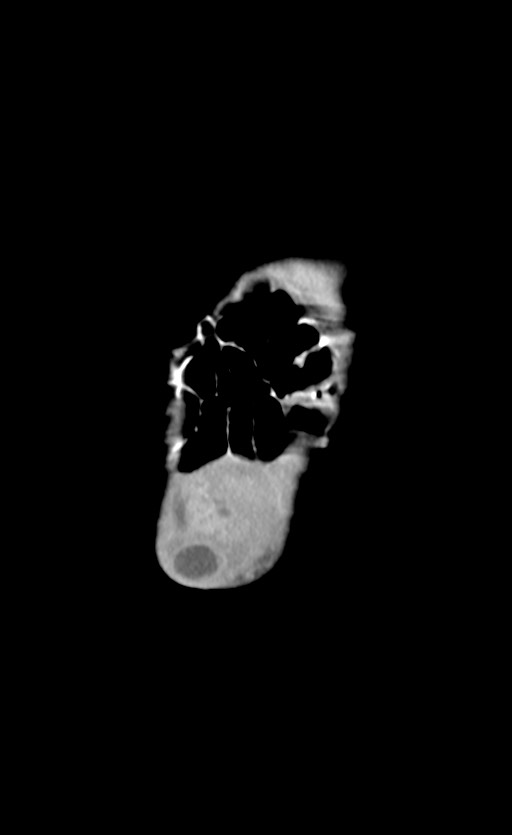 Abdominopelvic rhabdomyosarcoma (Radiopaedia 78356-90984 Coronal C+ portal venous phase 5).jpg