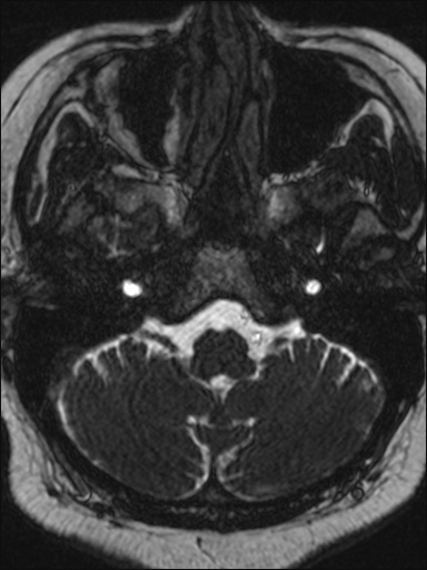 File:Abducens nerve palsy (Radiopaedia 57084-63976 Axial T2 ciss 3d 12).jpg