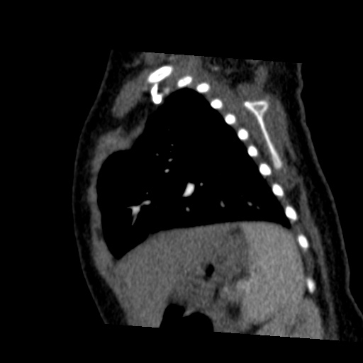 Aberrant left pulmonary artery (pulmonary sling) (Radiopaedia 42323-45435 Sagittal C+ arterial phase 43).jpg