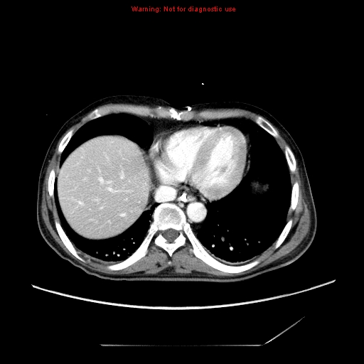 File:Aberrant right subclavian artery (Radiopaedia 9379-10071 Axial C+ arterial phase 50).jpg
