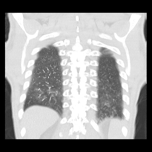 Accessory left horizontal fissure with lingular pneumonia (Radiopaedia 53763-59843 Coronal lung window 38).jpg