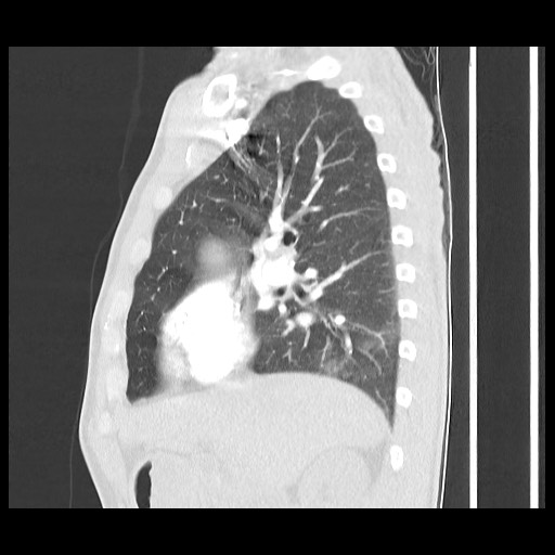 Accessory left horizontal fissure with lingular pneumonia (Radiopaedia 53763-59843 Sagittal lung window 27).jpg