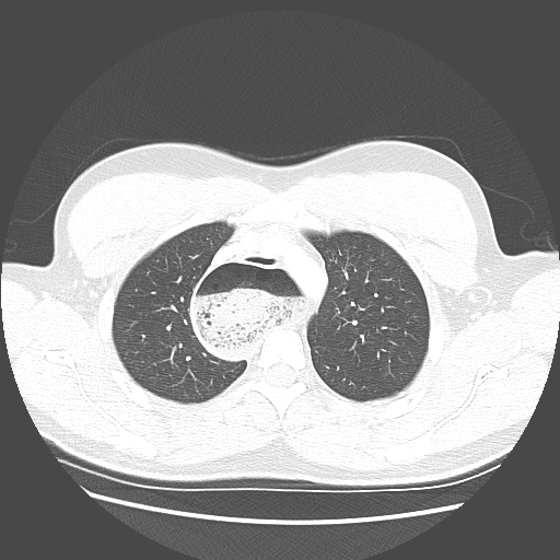 Achalasia (Radiopaedia 52507-58417 Axial lung window 15).jpg
