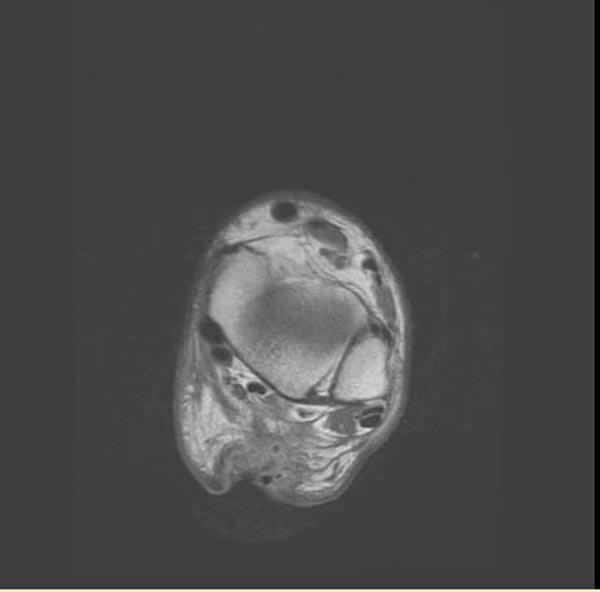 File:Achilles tendon rupture (Radiopaedia 11159-11524 None 4).jpg