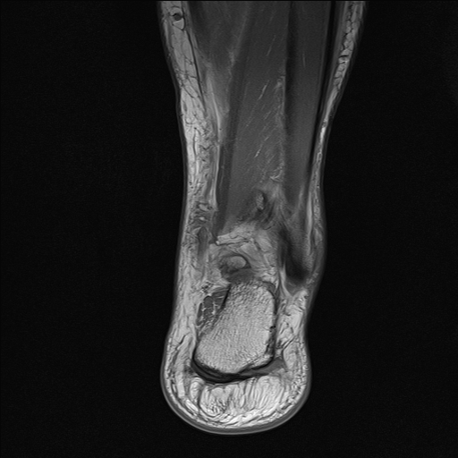 File:Achilles tendon tear (Radiopaedia 77615-89819 Coronal T1 22).jpg
