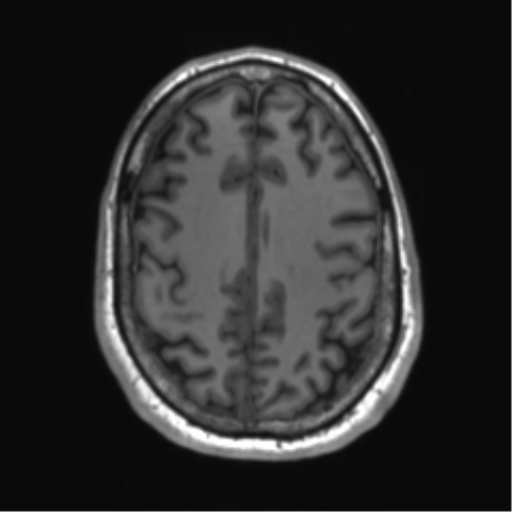File:Achondroplasia (Radiopaedia 65109-74105 Axial T1 13).png
