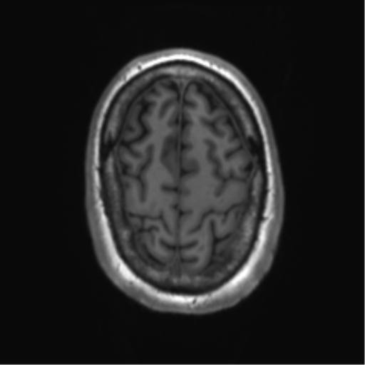 File:Achondroplasia (Radiopaedia 65109-74105 Axial T1 8).png