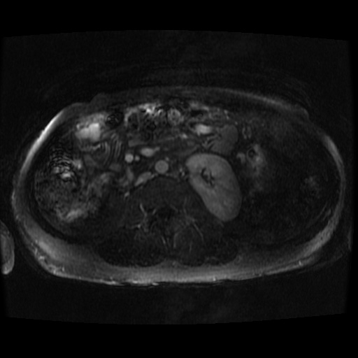 Acinar cell carcinoma of the pancreas (Radiopaedia 75442-86668 Axial T1 C+ fat sat 12).jpg