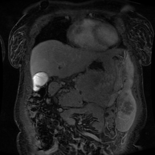 Acinar cell carcinoma of the pancreas (Radiopaedia 75442-86668 Coronal T1 C+ fat sat 140).jpg