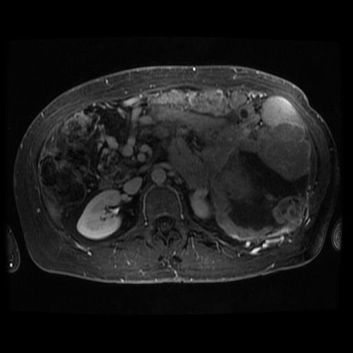Acinar cell carcinoma of the pancreas (Radiopaedia 75442-86668 D 44).jpg