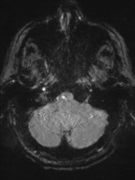 Acoustic schwannoma (Radiopaedia 55729-62281 Axial SWI 7).png