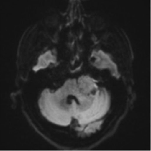 Acoustic schwannoma (Radiopaedia 55729-62281 E 32).png