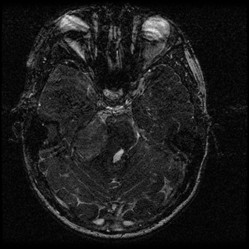 Acoustic schwannoma - eroding petrous apex (Radiopaedia 39674-42004 Axial T2 66).png