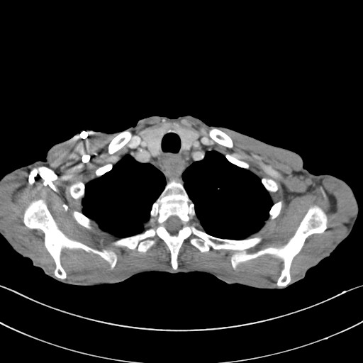 File:Acquired tracheoesophageal fistula (Radiopaedia 57747-65042 Axial C+ portal venous phase 11).jpg