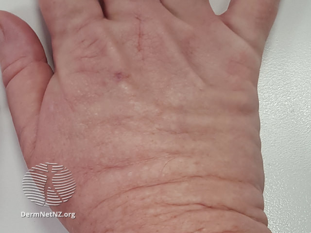 File:Acral persistent papular mucinosis (DermNet NZ acral-persistent-papular-mucinosis-02).jpg