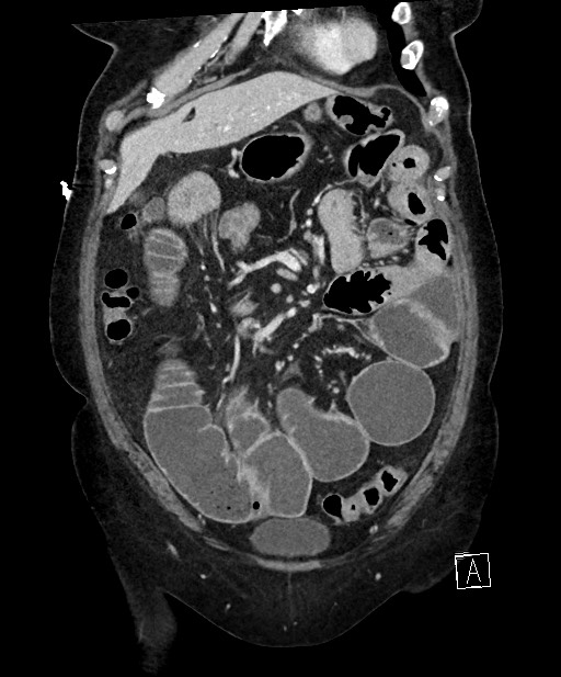 Active Crohn disease (Radiopaedia 59394-66750 Coronal C+ portal venous phase 23).jpg