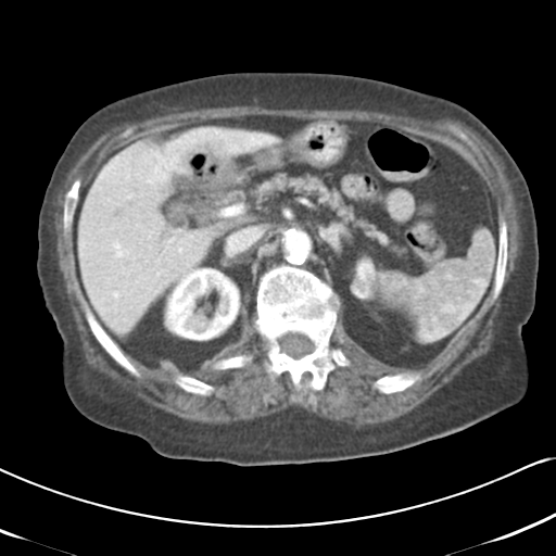 File:Active bleeding from duodenal ulcer with embolization (Radiopaedia 34216-35481 C 21).png