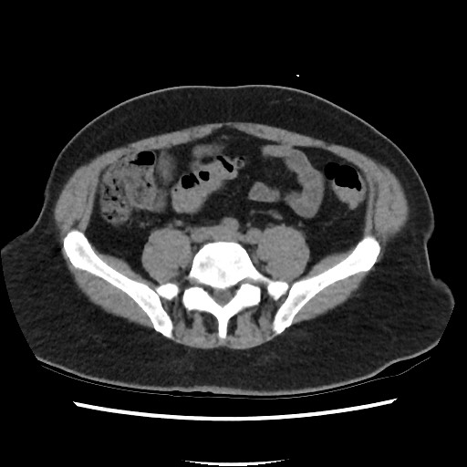 Active colonic bleed on CT (Radiopaedia 49765-55025 Axial non-contrast 56).jpg