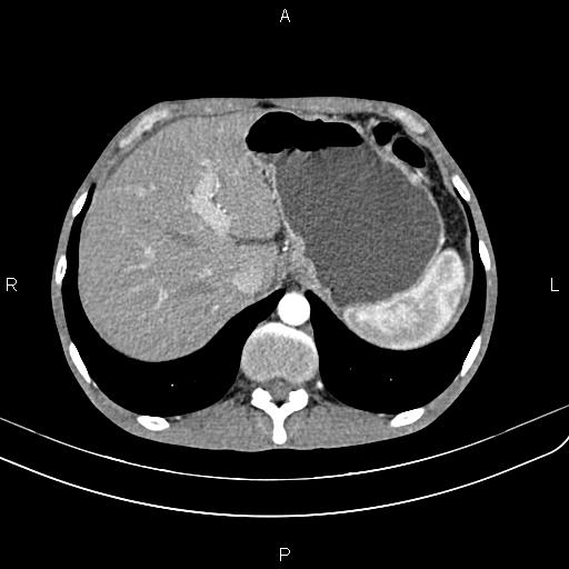 Active crohn disease (Radiopaedia 87133-103397 Axial C+ arterial phase 21).jpg
