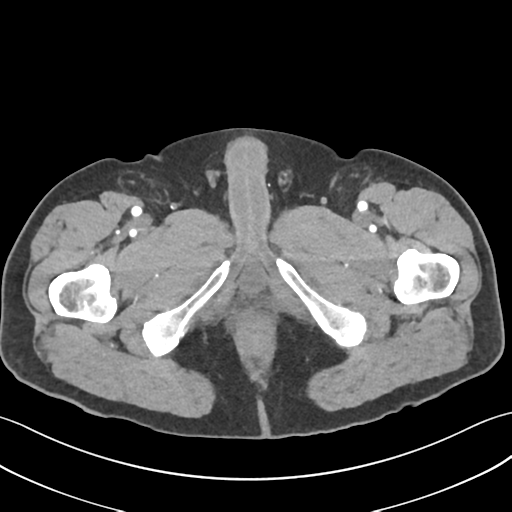 File:Active diverticular hemorrhage (Radiopaedia 39415-41725 Axial C+ arterial phase 79).png