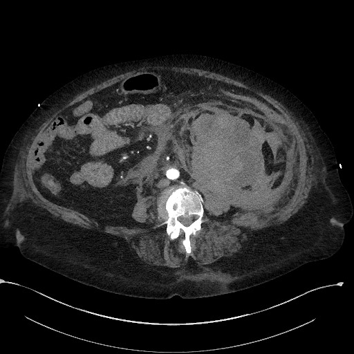 File:Active renal extravasation with large subcapsular and retroperitoneal hemorrhage (Radiopaedia 60975-68796 Axial C+ arterial phase 108).jpg