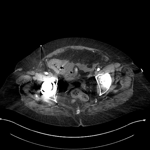 Active renal extravasation with large subcapsular and retroperitoneal hemorrhage (Radiopaedia 60975-68796 Axial C+ arterial phase 180).jpg