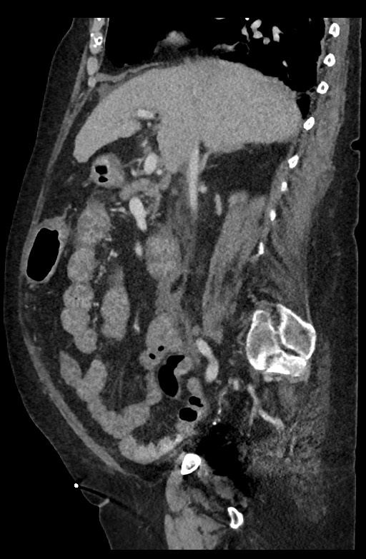 Active renal extravasation with large subcapsular and retroperitoneal hemorrhage (Radiopaedia 60975-68796 Sagittal C+ portal venous phase 137).jpg
