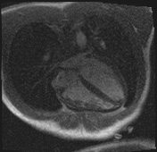 Active right ventricular cardiac sarcoidosis (Radiopaedia 55596-62100 Axial Dynamic perfusion scan MOCO 51).jpg