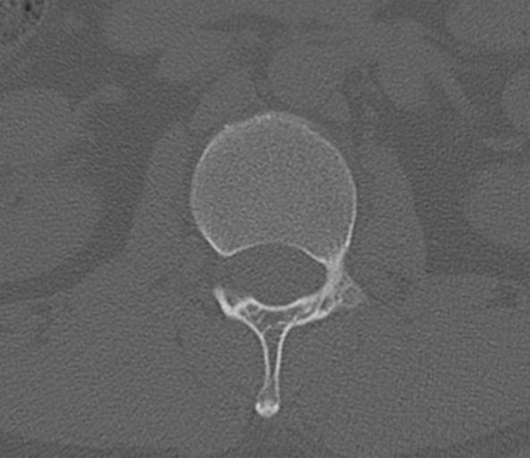 File:Acute L1 burst compression fracture (Radiopaedia 34430-35755 Axial bone window 25).png