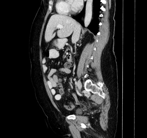 Acute appendicitis, heterotaxy syndrome (Radiopaedia 66884-76202 Sagittal C+ portal venous phase 80).jpg