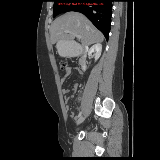 File:Acute appendicitis (Radiopaedia 10498-10973 Sagittal C+ portal venous phase 13).jpg