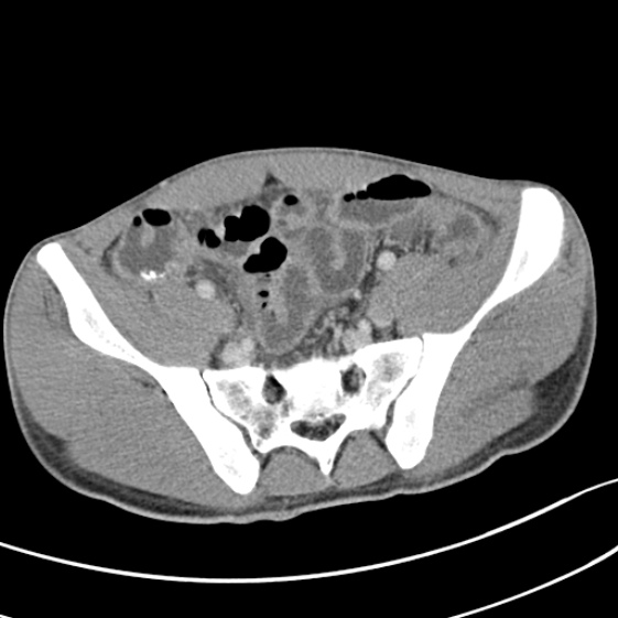 File:Acute appendicitis (Radiopaedia 32614-33572 Axial C+ portal venous phase 51).jpg