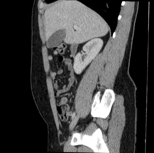 Acute appendicitis (Radiopaedia 38255-40270 Sagittal C+ portal venous phase 29).jpg