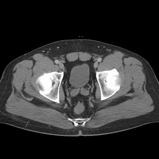 Acute appendicitis (Radiopaedia 48511-53463 Axial C+ portal venous phase 95).jpg