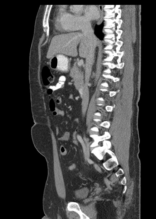 Acute appendicitis (Radiopaedia 48511-53463 Sagittal C+ portal venous phase 65).jpg