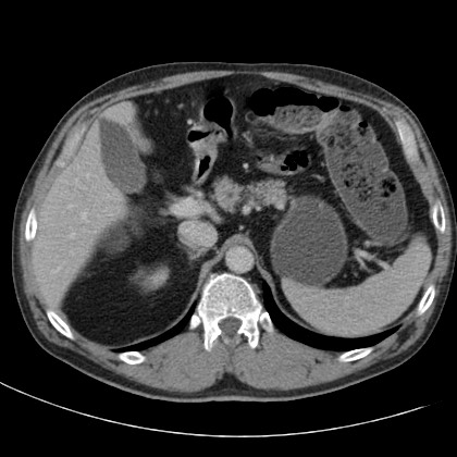 File:Acute appendicitis (Radiopaedia 66513-75790 Axial C+ portal venous phase 12).jpg