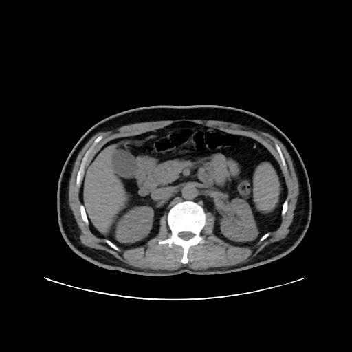 Acute appendicitis and COVID 19 pneumonia (Radiopaedia 76604-88380 Axial non-contrast 65).jpg