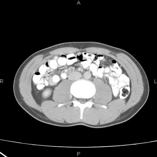 File:Acute appendicitis with CT arrowhead sign (Radiopaedia 21474-21411 Axial C+ portal venous phase 20).jpg