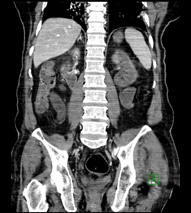 Acute arterial mesenteric ischemia (Radiopaedia 78238-90828 Coronal C+ portal venous phase 62).jpg